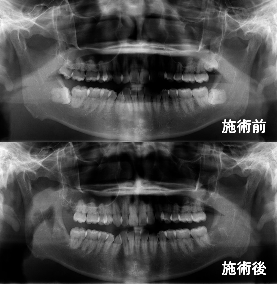 親知らず専門外来症例1