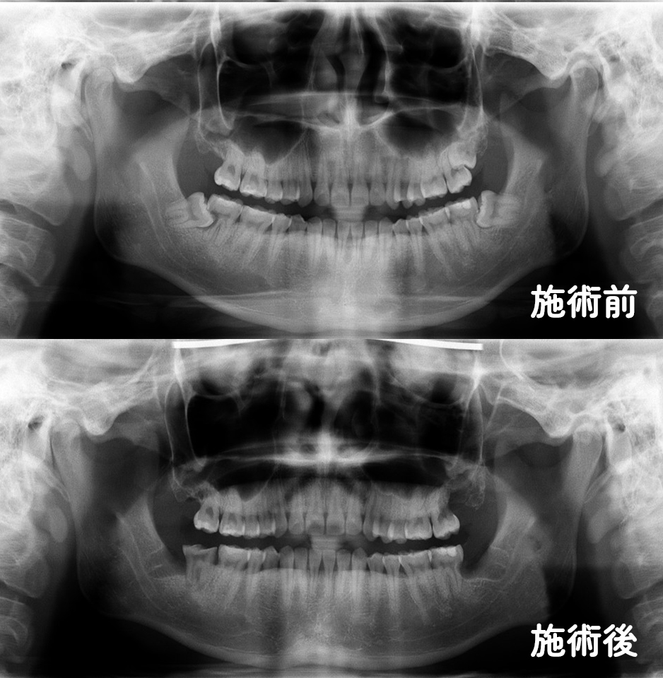 親知らず専門外来症例3